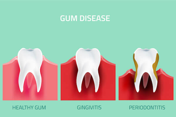 Gingivitis dan Periodontitis